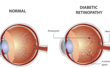 Dia Mundial do Diabetes: controle da glicose também protege a visão
