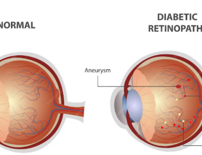 Dia Mundial do Diabetes: controle da glicose também protege a visão